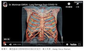 美國一所醫院利用電腦斷層掃描成像技術，製作武漢肺炎患者肺部多處受損的影像。醫師說，部分人的損傷無可挽救，大家真的必須認真保持社交距離及自我隔離，避免感染。(圖/翻攝自youtube)