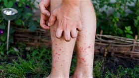 蕁麻疹（圖／平安中醫診所提供）