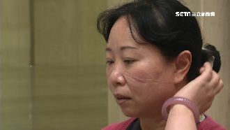 臉被口罩壓花　廠商送敷料助「修臉」