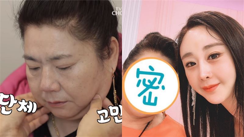 灑4百萬帶婆婆整形　合照見驚人成果