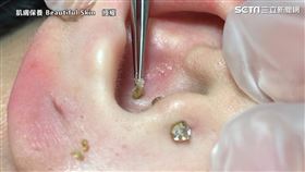 爽度爆表！美容師巧手消滅粉刺　1分半過程網跪著看完