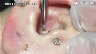 拉出粉刺爽度爆表　網跪著看完1分半