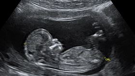 （圖／翻攝自維基百科）產檢,超音波,胎兒