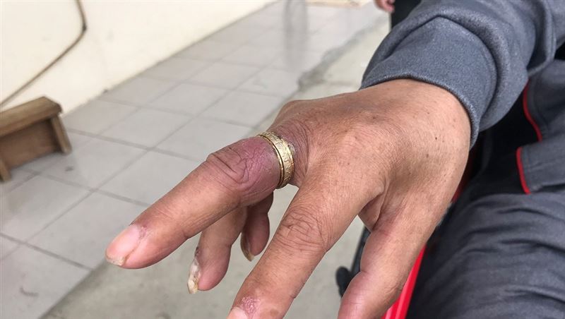 男戴金戒指卡中指未拔　慘潰爛又發黑