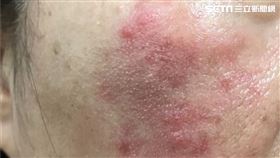 酒糟性皮膚炎,武漢肺炎,戴口罩,台北慈濟醫院,皮膚科,陳志斌,酒糟肌
圖／台北慈院提供