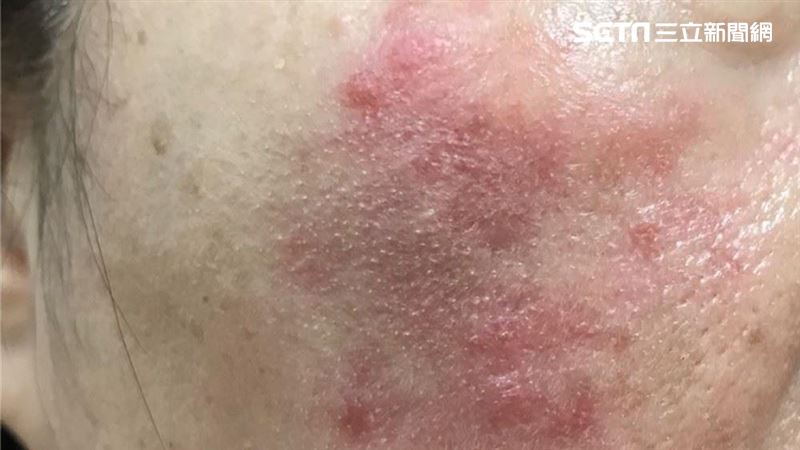 防疫口罩一戴六小時　婦人酒糟肌復發