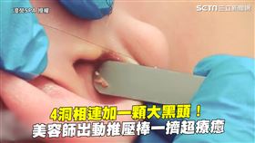 4洞相連加一顆大黑頭！　美容師出動推壓棒一擠超療癒