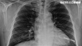 阮綜合醫院,胸腔外科,林鴻生,鈦合金固定板,手術,骨折,肋骨
圖／阮綜合醫院提供