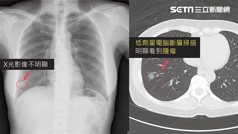 久咳1個月覺得怪　婦：好險有去檢查