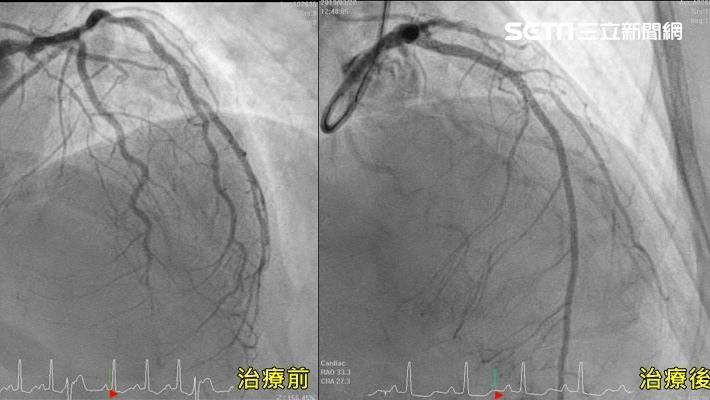壞膽固醇飆塞爆血管　45歲女心衰竭