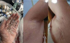 離婚前「皮膚潰爛、臉變形」！驚覺是醫生尪投毒謀殺（圖／翻攝自微博）