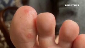 腳趾看染疫1800