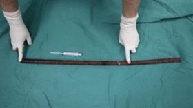 中國大陸一工人肛門遭鋼筋插入貫穿體腔（圖／翻攝自微博）
