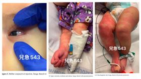 川崎氏症。（圖／吳昌騰醫師提供）