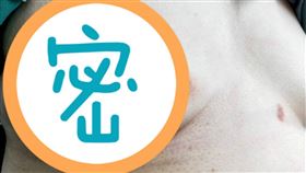 「皮蛇」帶狀疱疹再度纏人　長在她的乳暈旁「走路都會痛」