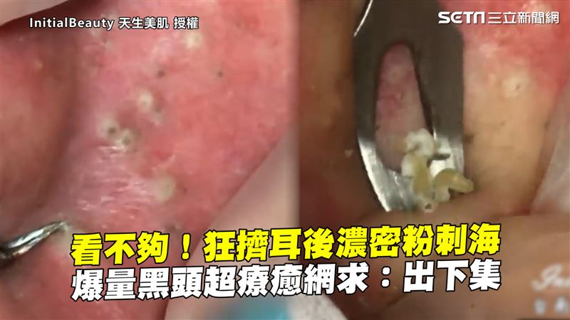 耳後粉刺海超狂　狂擠過程網讚超療癒