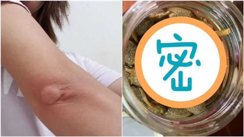 蚊子狂咬！她曝「天然止癢藥」網推爆
