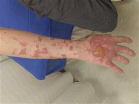 新北市張男被女同事潑灑熱油，導致右手及上半身多處燙傷。（圖／翻攝臉書社團《我是土城人》）