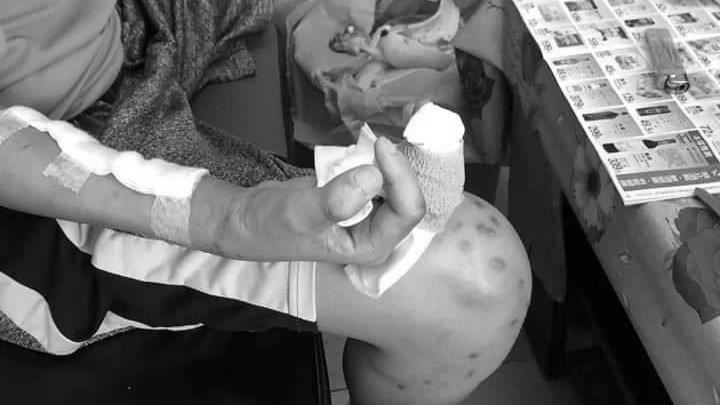 孝順少年打工遭凌虐截趾　惡老闆收押