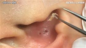 輕柔旋轉3分鐘清除耳朵粉刺　酥麻程度網嘆：人間享受