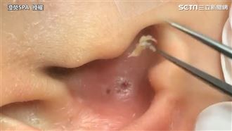 3分鐘清粉刺　酥麻程度網嘆：享受啊