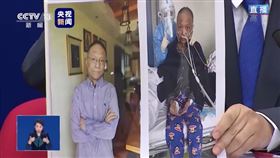 湖北省武漢市中心醫院心臟大血管外科副主任醫師易凡罹患武漢肺炎，救治過程中全身暗沉臉發黑（右，4月6日拍攝），如今膚色已明顯變白（左，5月9日上午拍攝）。（圖取自央視畫面）