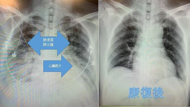 小感冒一週後竟胸悶氣喘成「心肌炎」