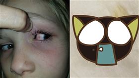 美國小女孩遭蟲蟲入侵，眼球流膿，9小時後才自己排出。（圖／翻攝自Kris Monk臉書）