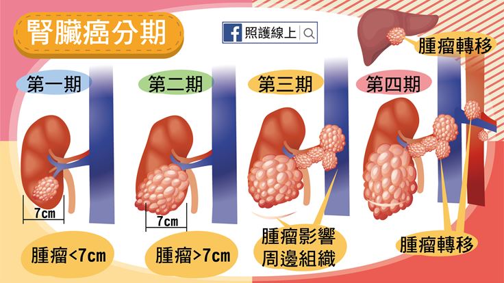 腎臟癌「默默長大」　6大警訊別忽略
