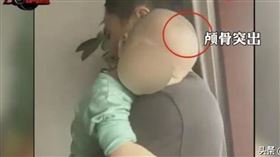 假奶粉,大頭娃娃,奶粉,固體蛋白,佝僂症（圖／翻攝微博-頭條新聞）