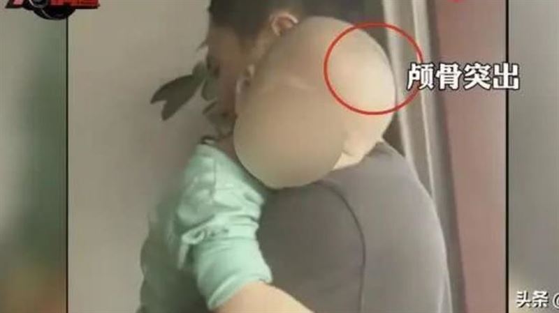 黑心店家賣假奶粉　害童頭骨畸形自毆