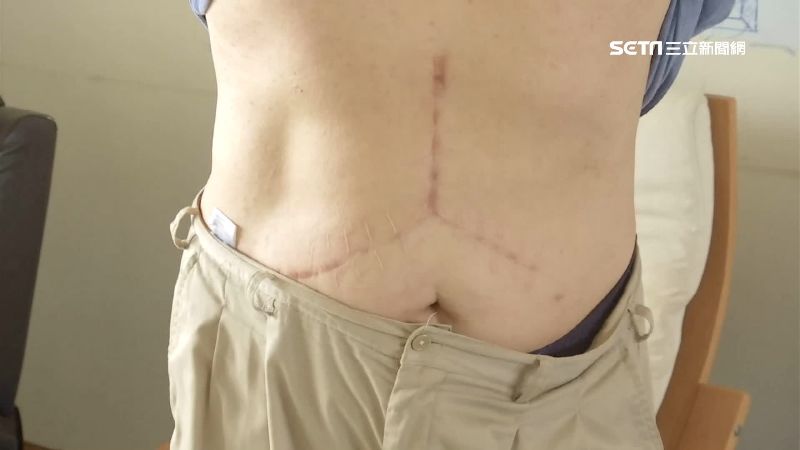 獨／陳肇隆換肝病患　賓士傷疤成印記