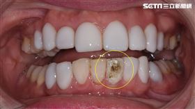 違法齒雕美白（牙醫林葳提供，勿用）