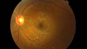 愛滋病,眼科,隱匿,視網膜