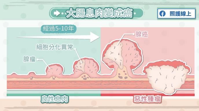 大腸息肉型態不一　有一種易變大腸癌