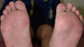 青少年足底皮膚病
（圖／成大醫院）