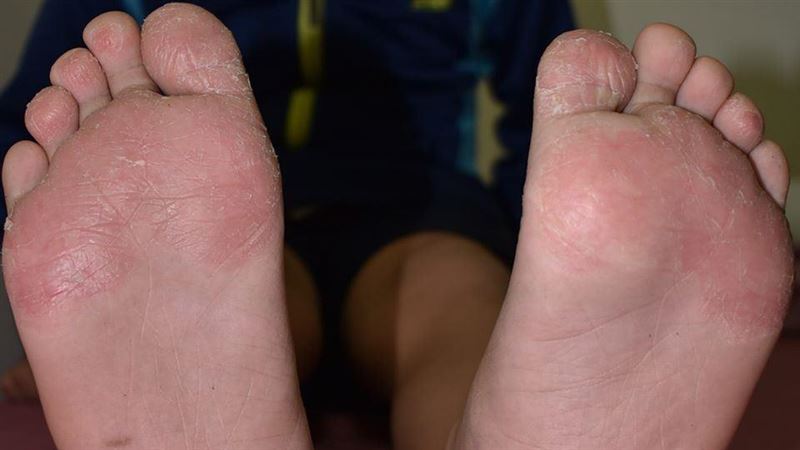 7歲童腳掌脫屑龜裂　其實不是香港腳