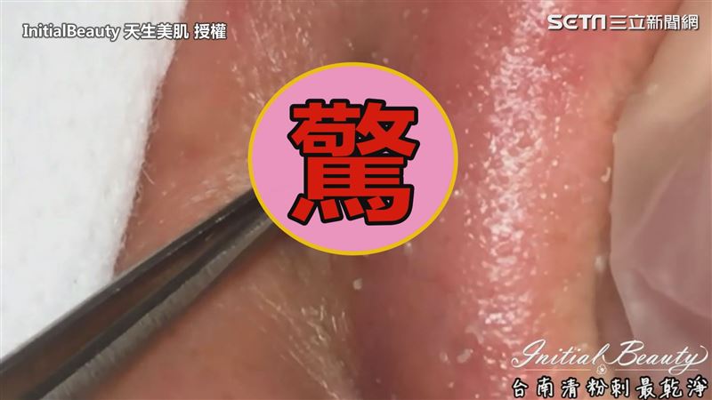 奶油花粉刺齊爆開　用力一擠出超暢快