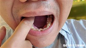 衛生福利部,台北醫院,耳鼻喉科,李家萱,口腔癌
圖／台北醫院、資料照