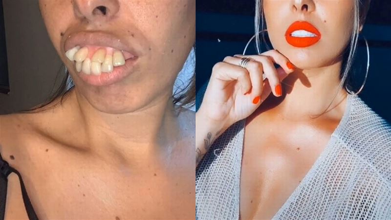 嫁牙醫前後差很大！暴牙女秀驚人變化