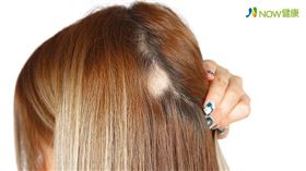 名家專用／NOW健康／女性常見的掉髮類型包括鬼剃頭、圓形禿、脂漏性（細菌感染）掉髮、雄性禿，其實根本原因皆出自頭皮膚是否健康。(勿用)