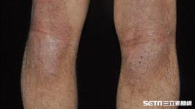 濕疹（皮膚科醫師黃毓惠提供）