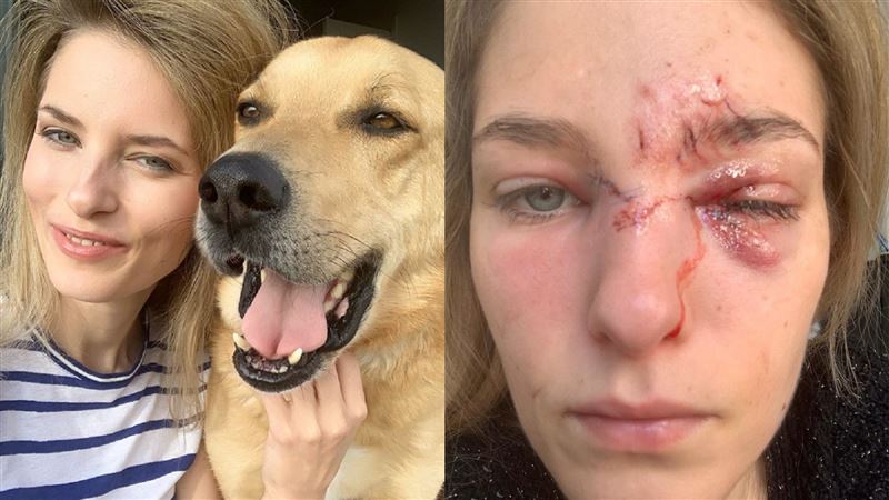 領養搜救犬發狂　名模「毀容」險失明