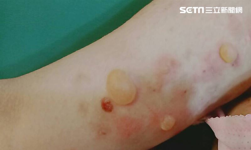 嘴破誤火氣大…下體長水泡　男罹罕病