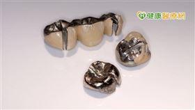 移除下來的汞牙（牙醫診所提供）