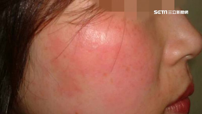 用降溫噴霧要小心　成分恐害過敏紅腫