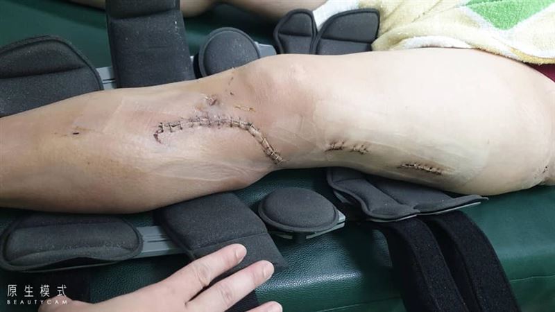 車禍腿斷成倒V形　肇事男遭控不聞問
