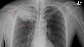 50多歲的男性患者、偶爾咳嗽一個多月，最近感到頭暈雙腳無力，就醫全身健檢後發現已經是肺癌末期，肺部已經有10公分大的腫瘤且合併腦部多轉轉移，剩餘壽命可能只有3個月！
圖／蘇一峰醫師提供

