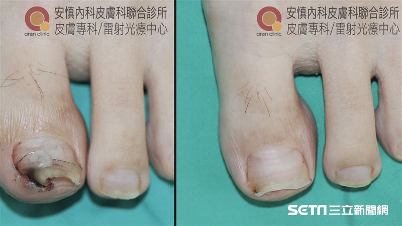 拔趾甲痛死人！治「凍甲」別無選擇？