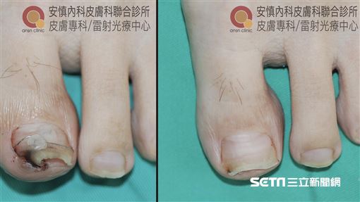 獨 拔趾甲 痛徹心扉 醫師 治療 凍甲 有其它方式 生活 三立新聞網setn Com